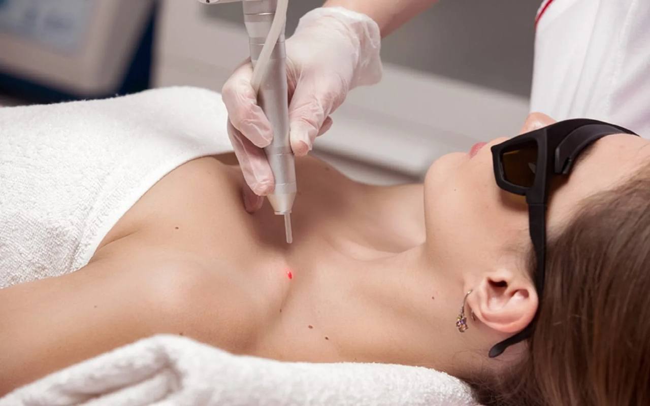 Почему эффективнее удалять новообразования лазером