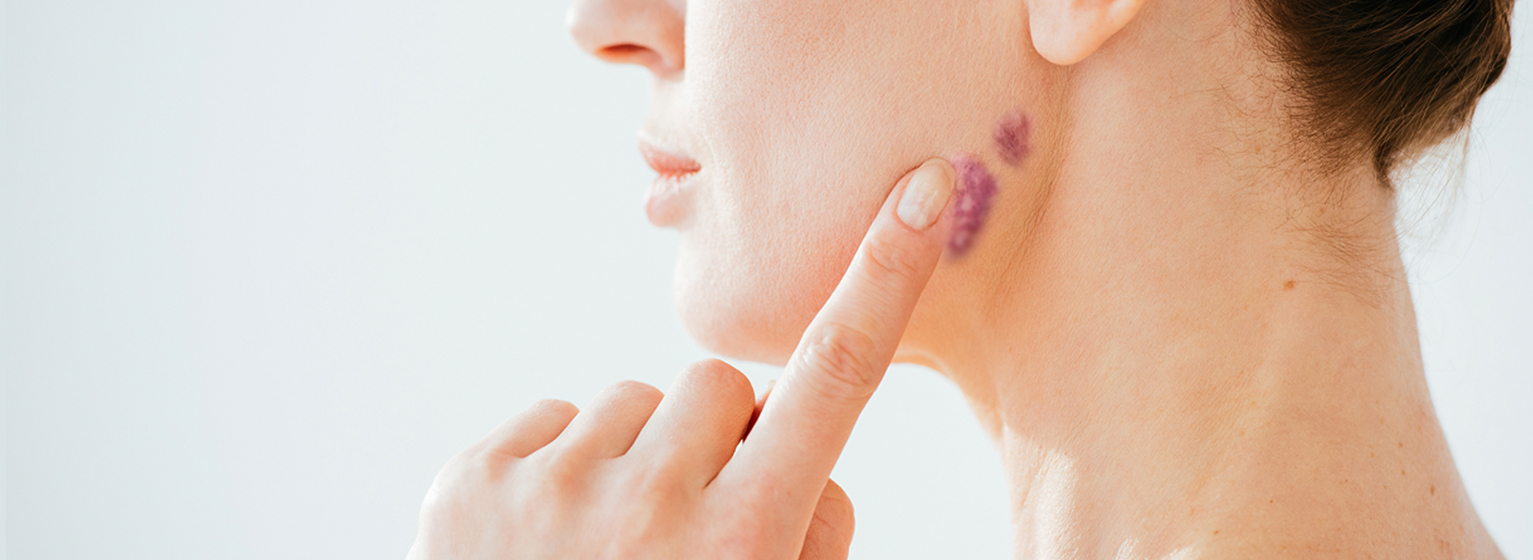 Удаление гемангиом