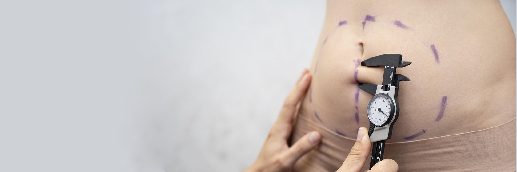 Абдоминопластика (подтяжка живота)