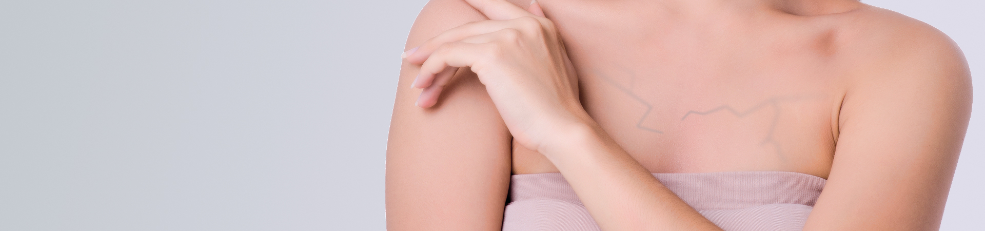 Удаление вен (сосудистых патологий) на груди лазером