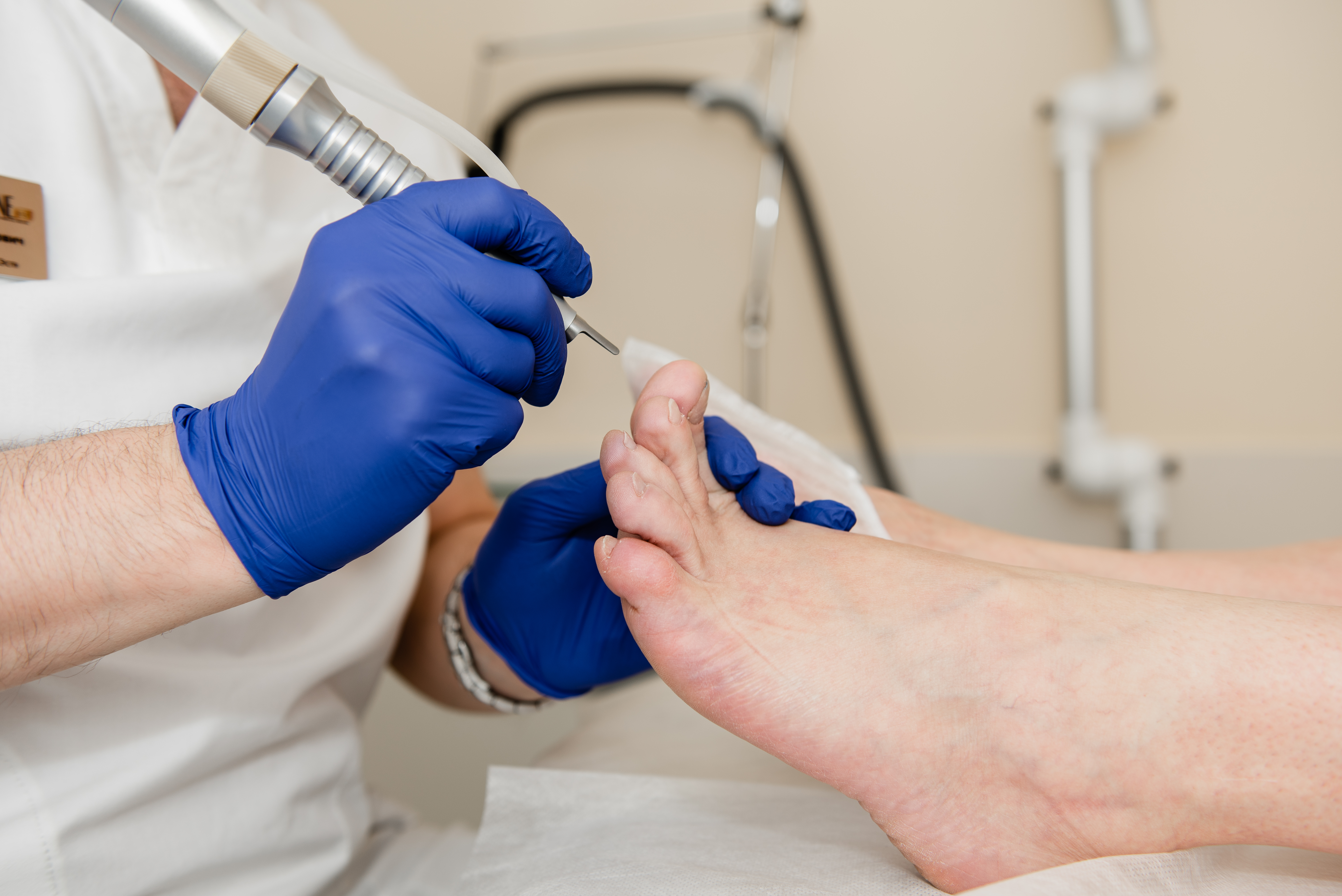 Удаление вросшего ногтя лазером CO 2