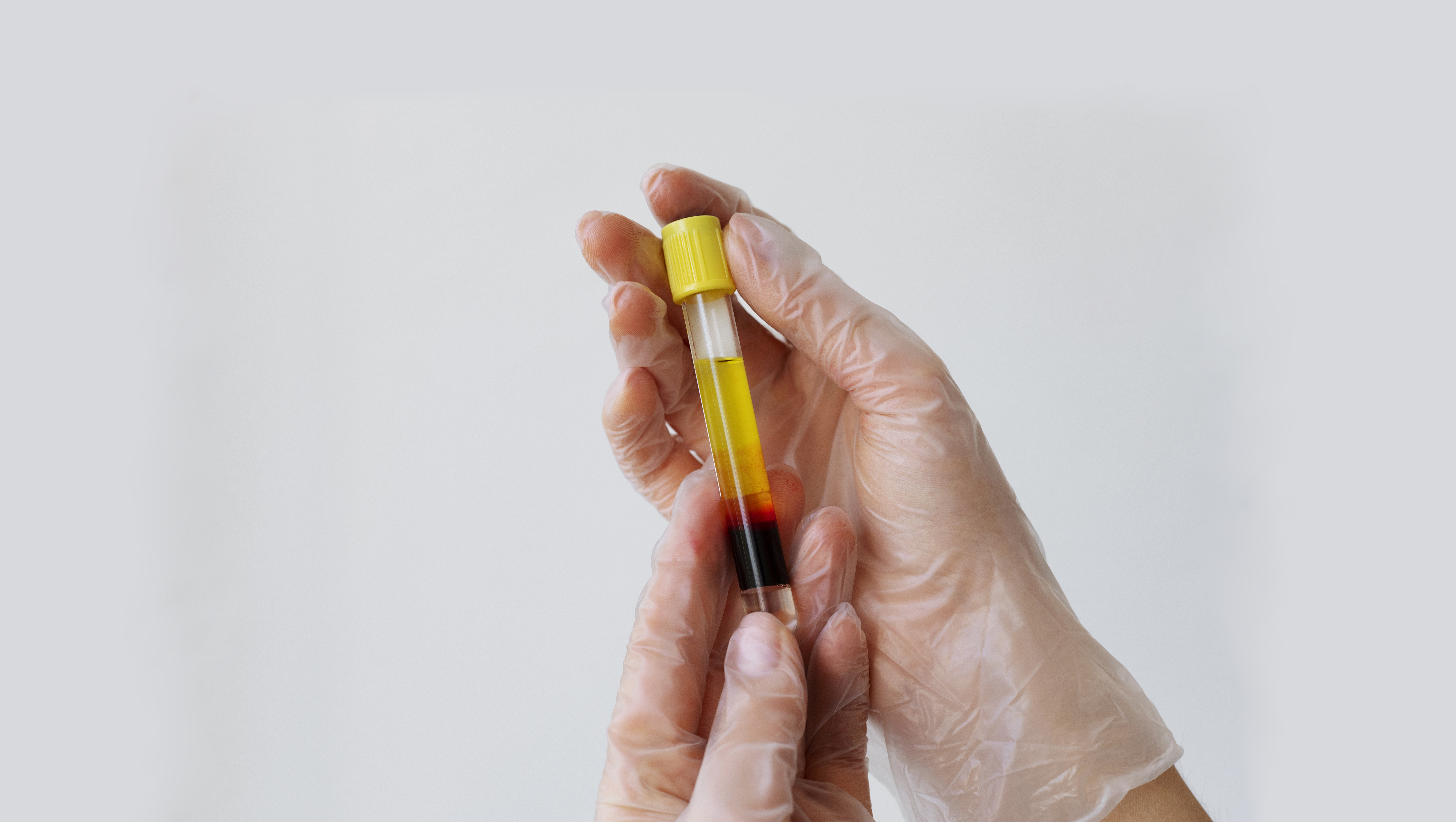 Плазмотерапия