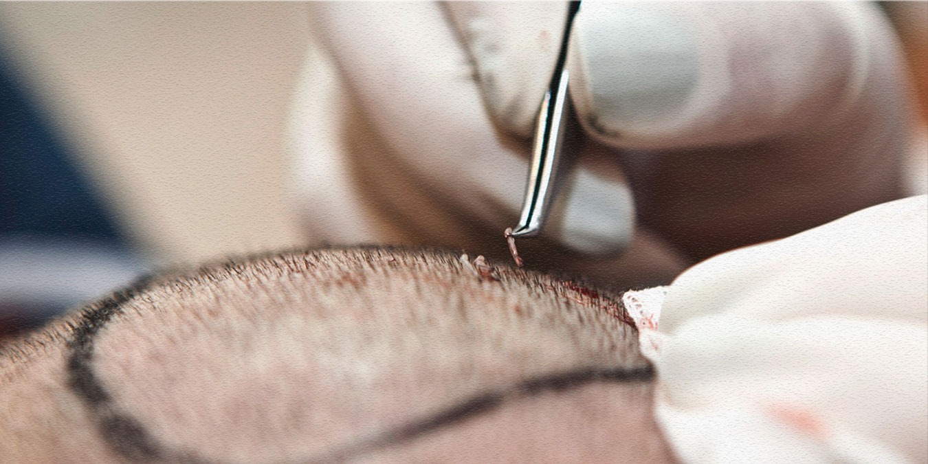 Трансплантация волос в ШайнЭст