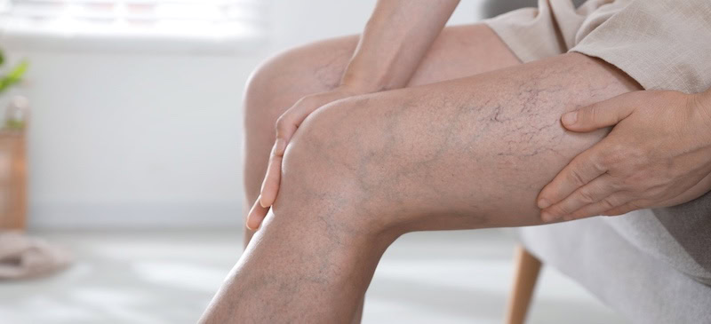 Эндовенозная лазерная коагуляция вен (ЭВЛК)