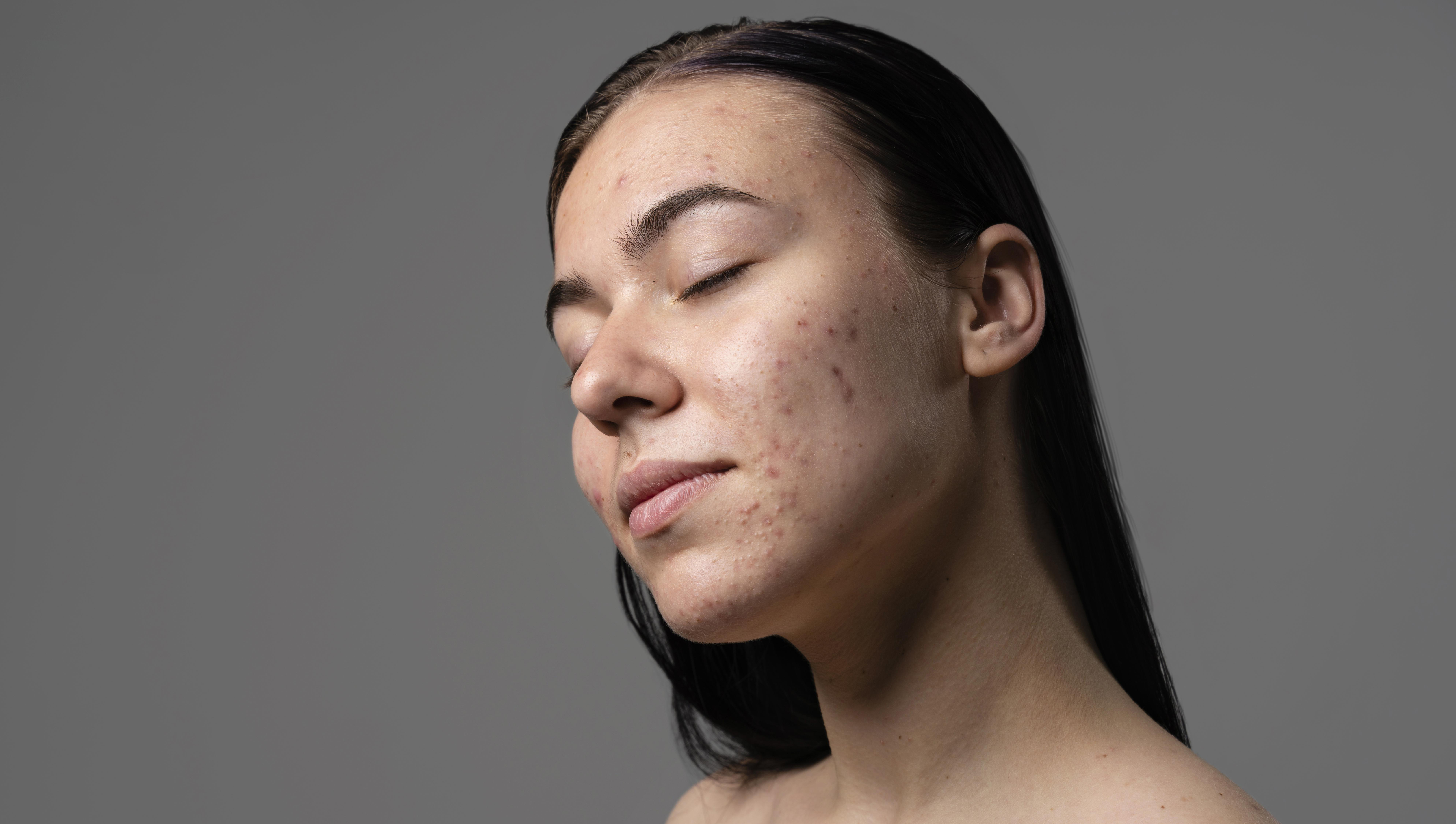 Лазерное лечение постакне