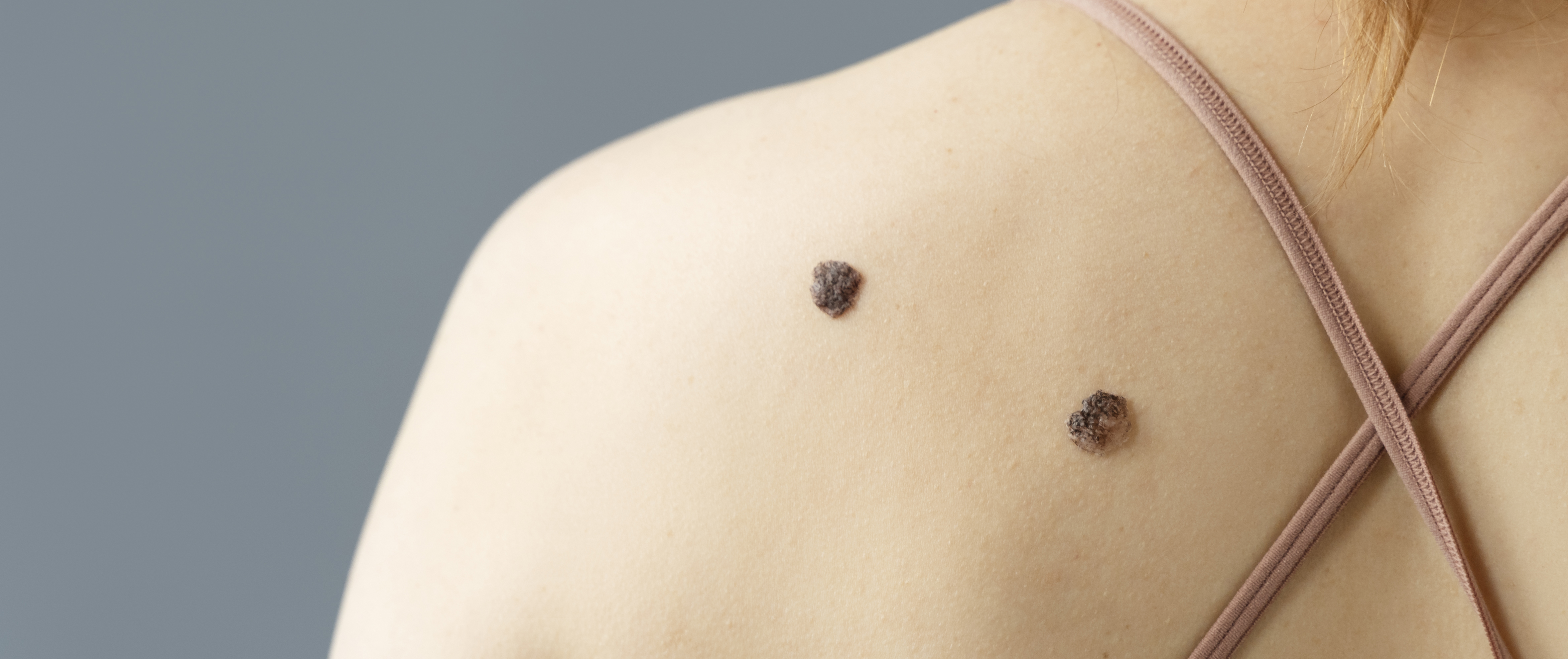 Удаление родинок