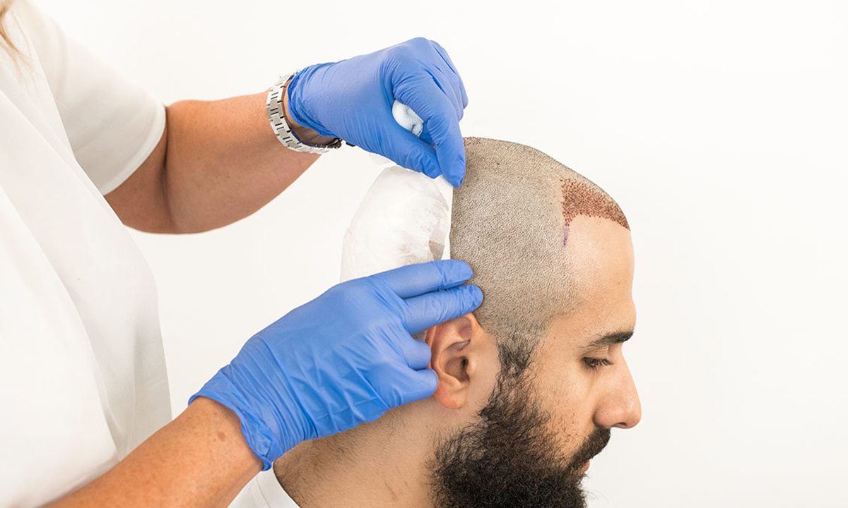 Трансплантация волос