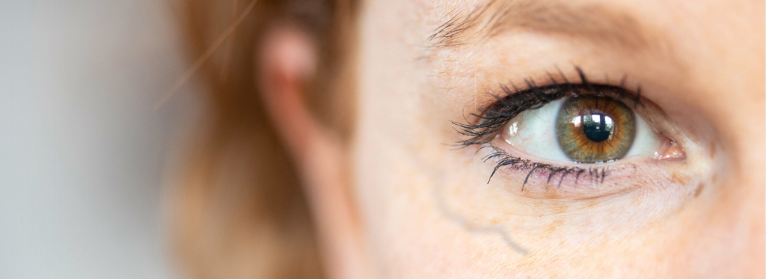 Лечение периорбитальных вен (удаление вен вокруг глаз)