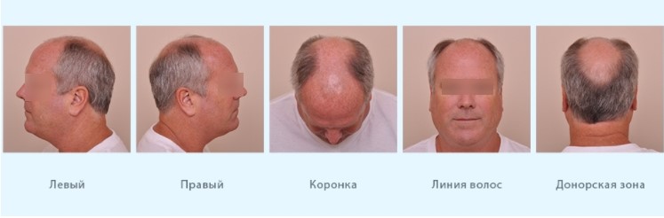 Пересадка волос