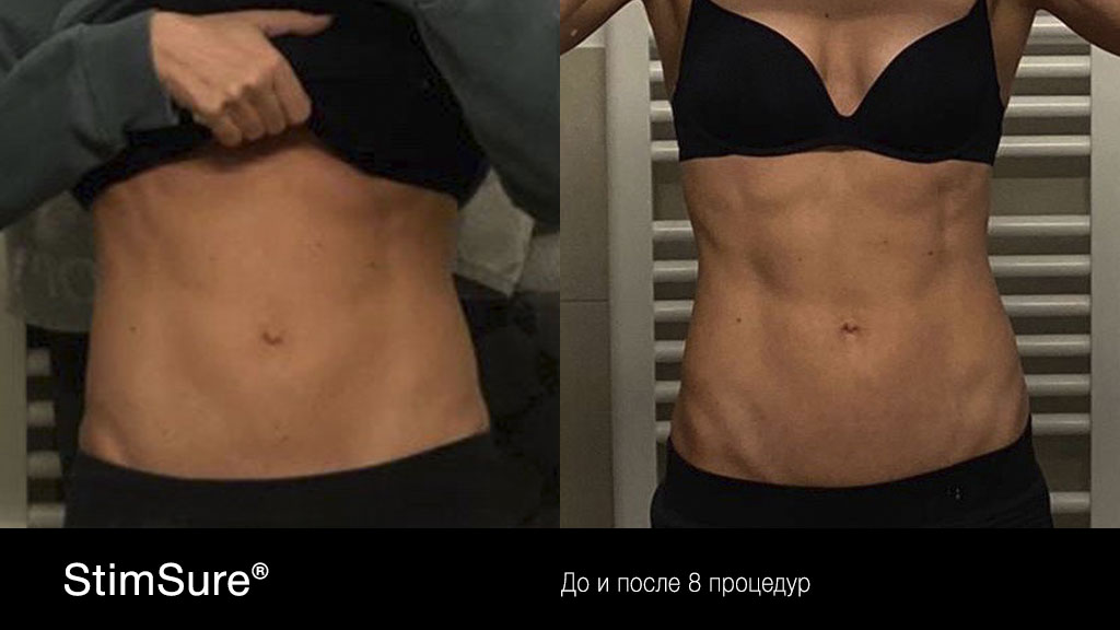 Новая технологи StimSure (Стимшур)